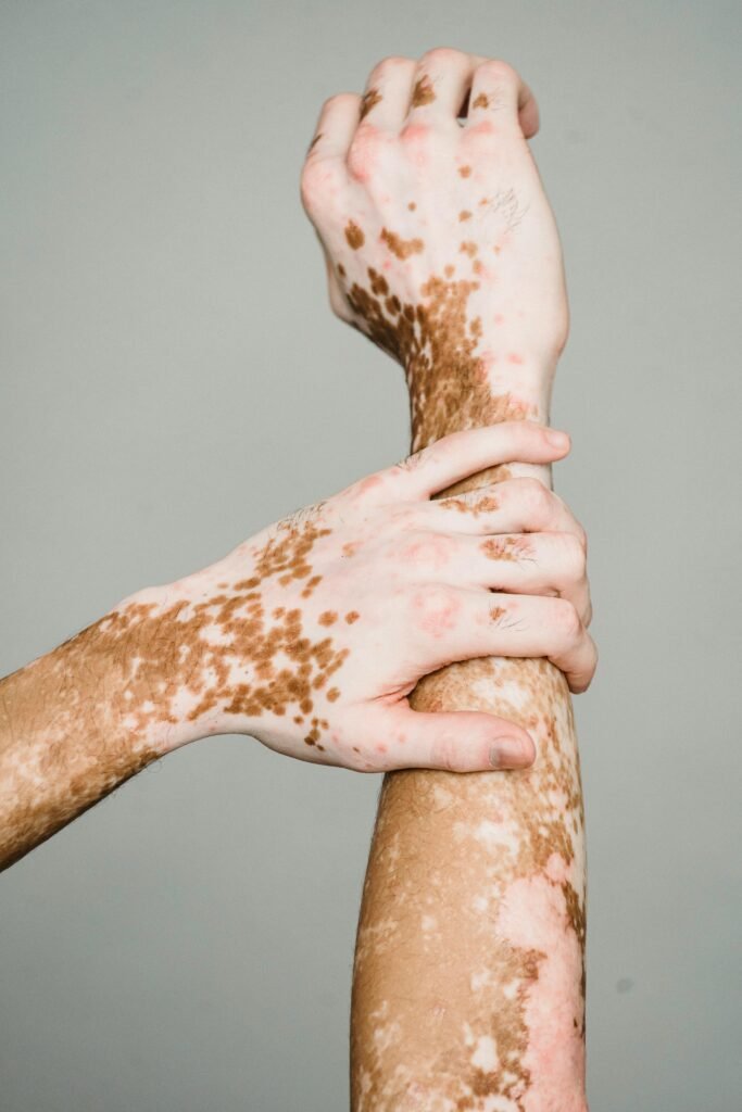 Detailed view of hands showing skin condition, highlighting unique patterns.